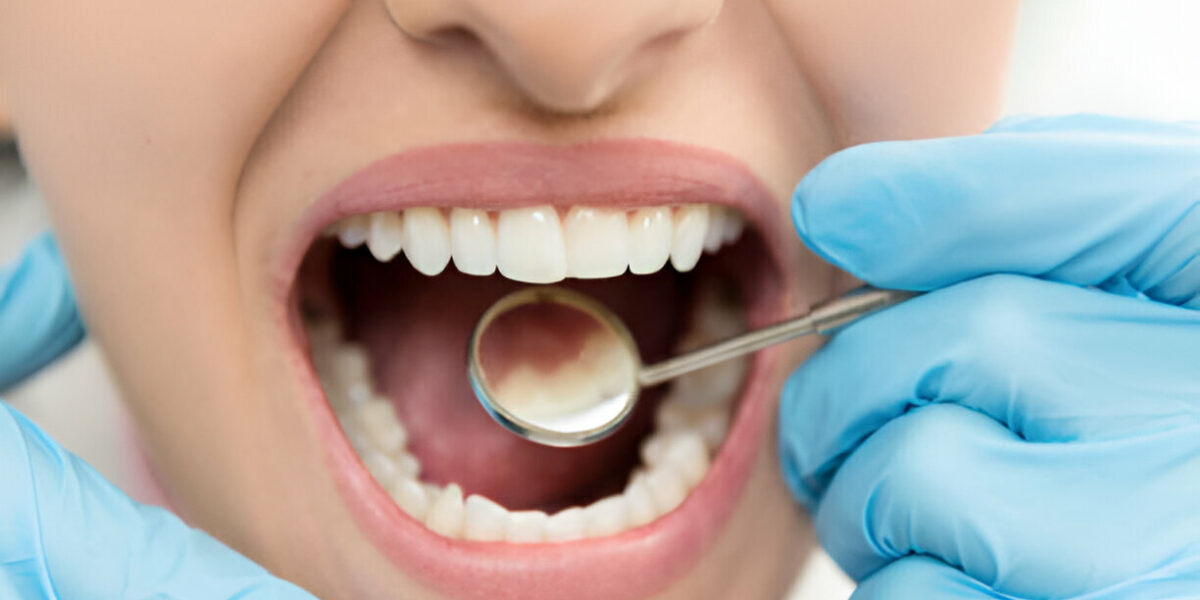 Dental Fillings in Fethiye Turkey