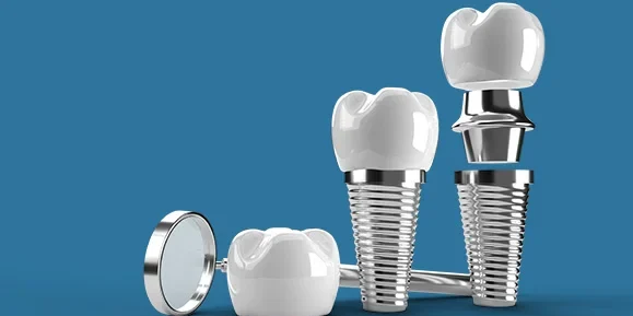 implant1 What is an Implant